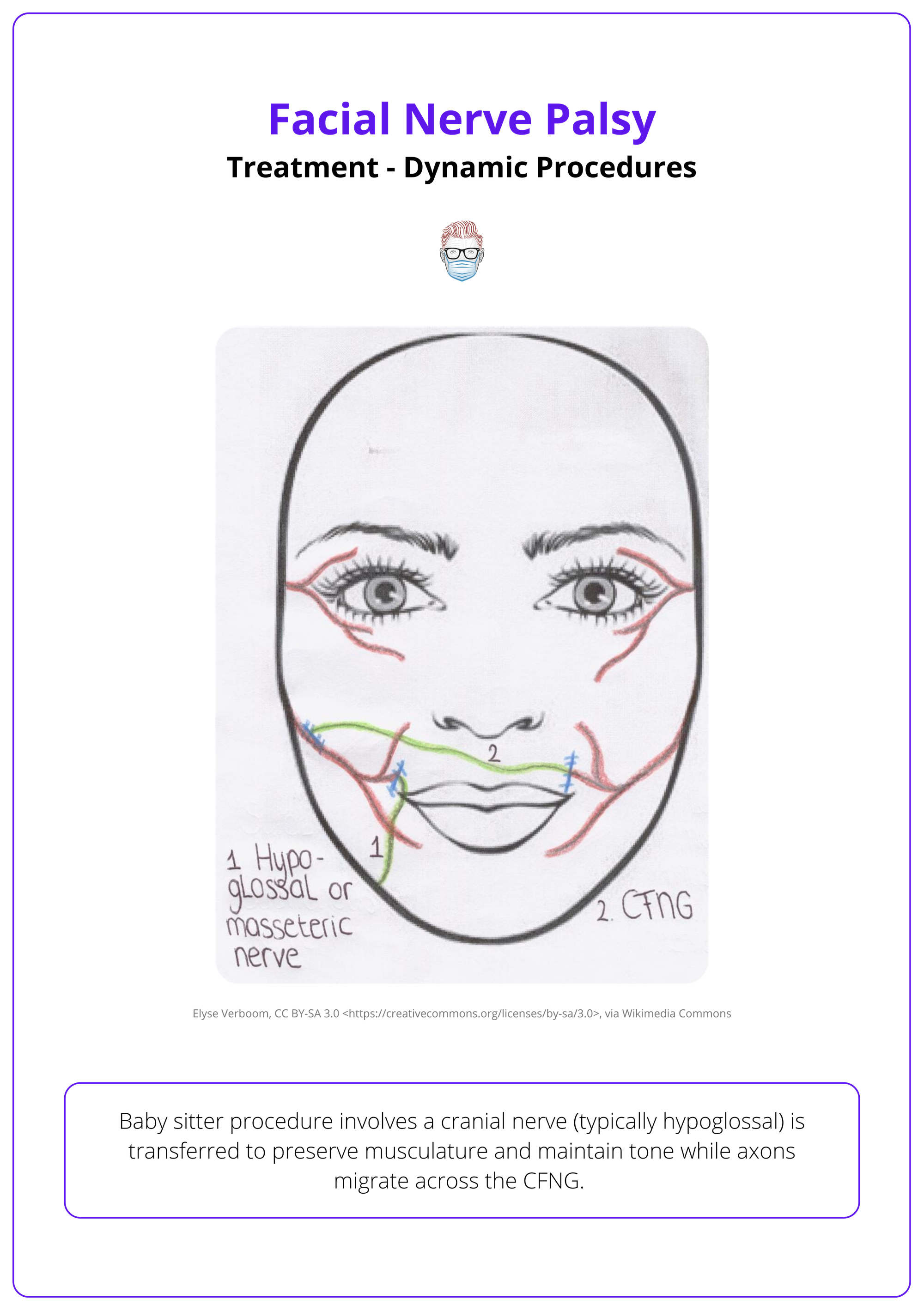 The babysitter procedure for treating facial nerve palsy