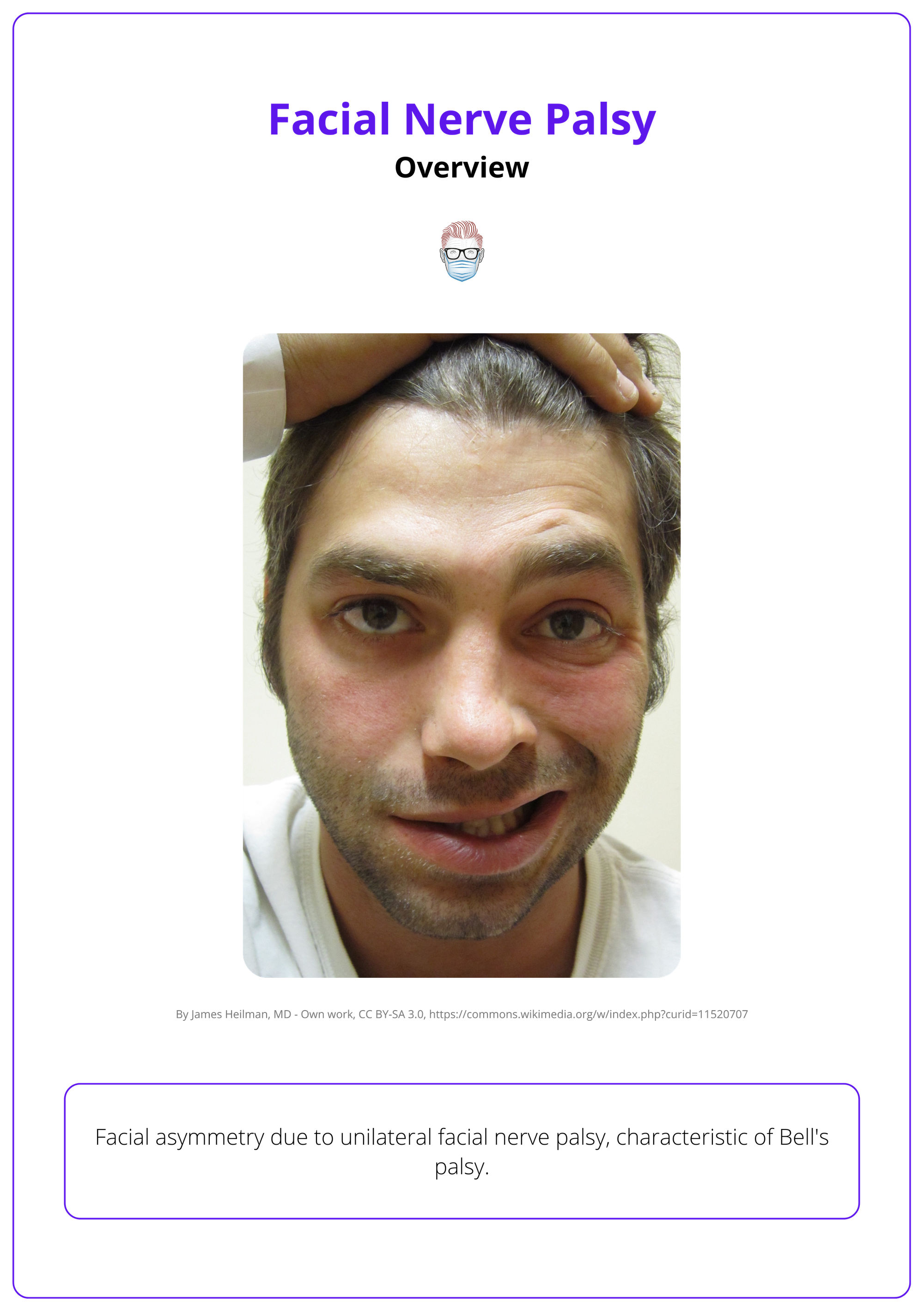 Right-sided facial palsy