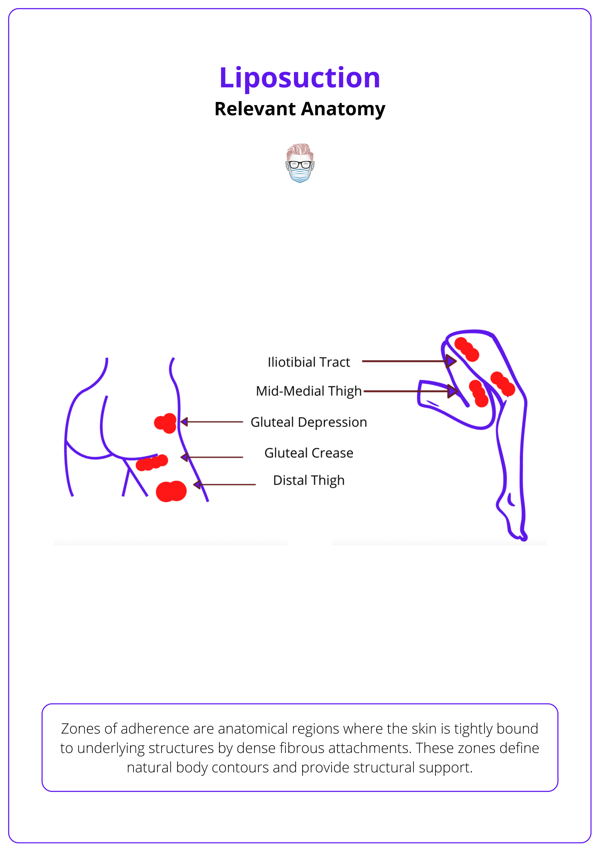 Zones of adherence to avoid in Liposuction