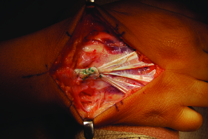 an intraoperative picture demonstrating the extensor carpi radialis longus (ECRL) sutured to the extensor digitorum communis using a Pulvertaft weave. 