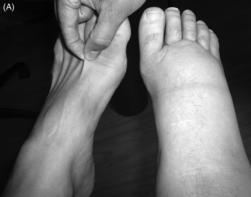 Stemmer’s sign for diagnosing lymphedema