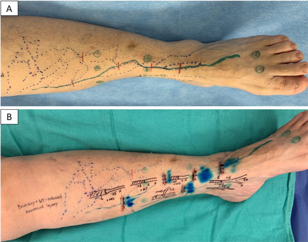 LVA Incision Planning