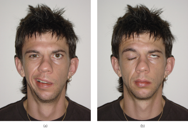 Left-sided lower motor neurone facial nerve palsy