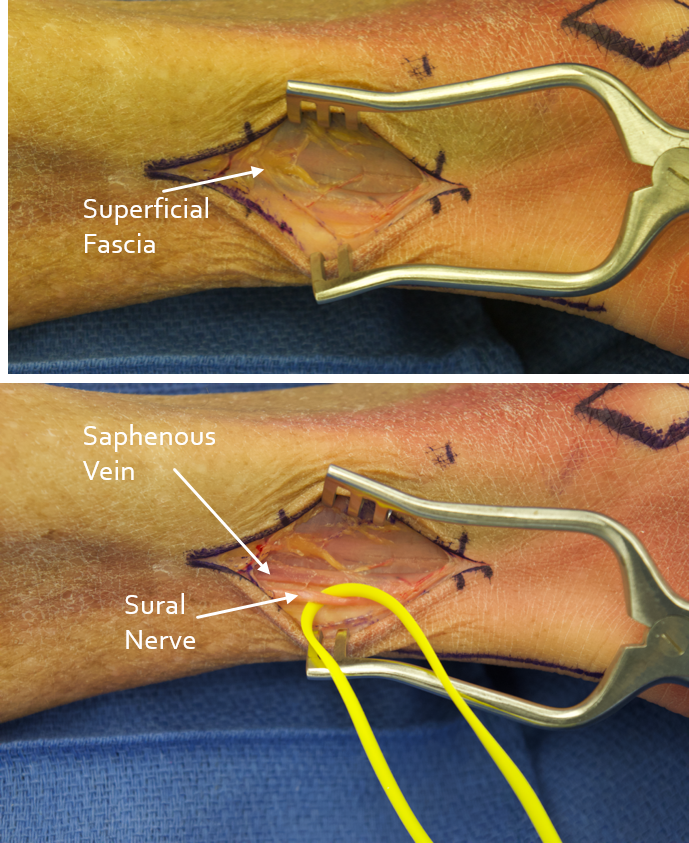 Sural nerve graft location for nerve reconstruction