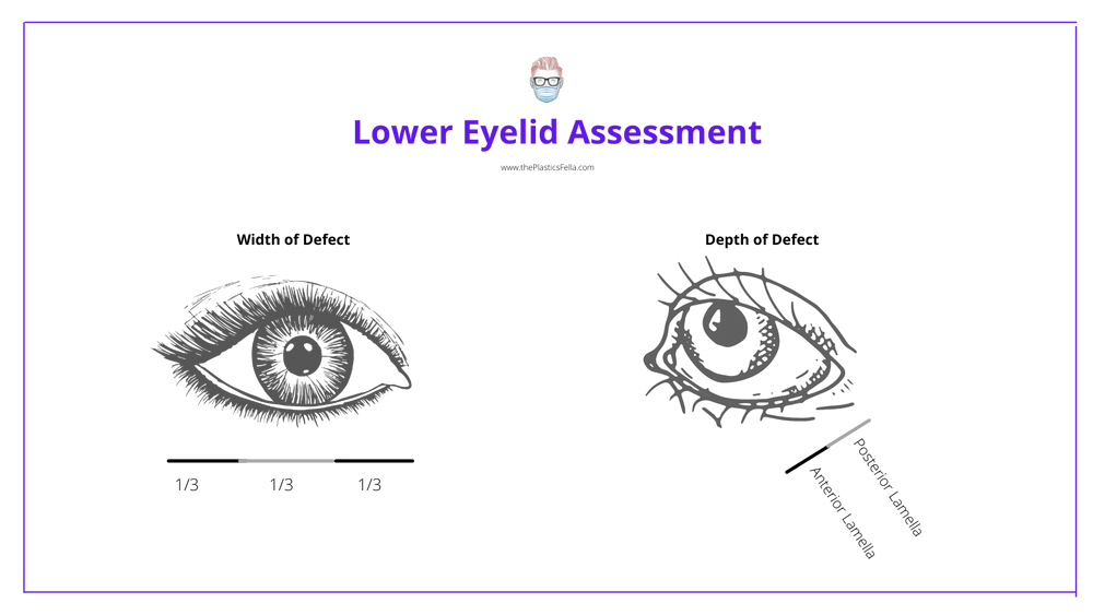 Lower Eyelid Reconstruction · Algorithm, Techniques & Illustrations