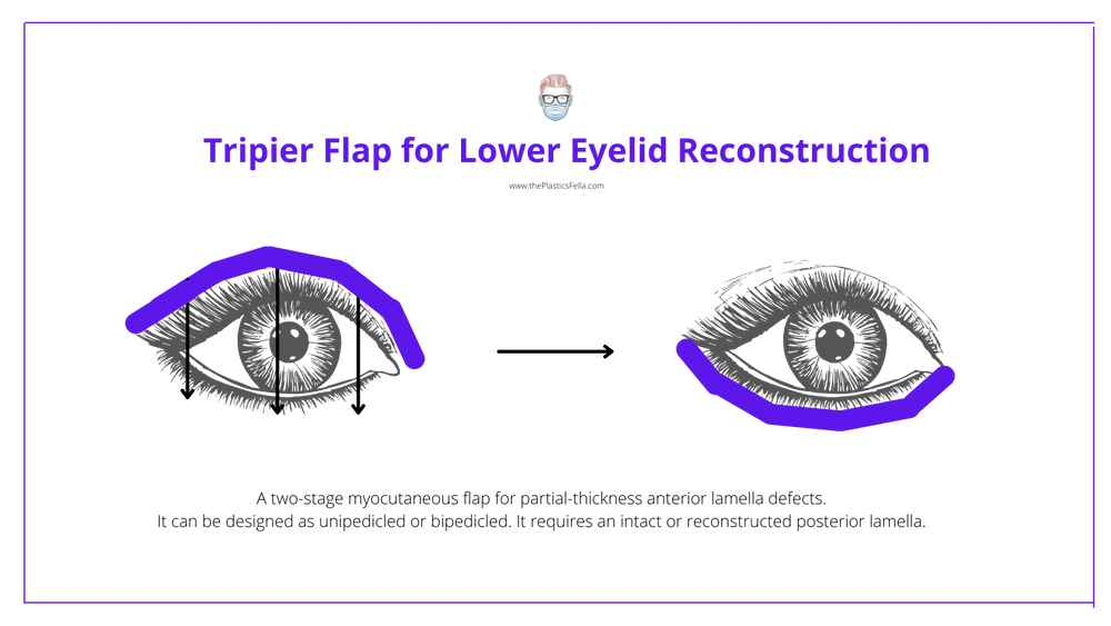 Lower Eyelid Reconstruction · Algorithm Techniques And Illustrations 