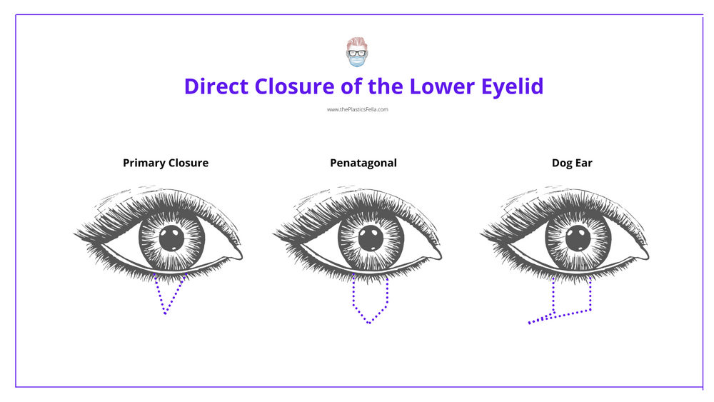 Lower Eyelid Reconstruction · Algorithm, Techniques & Illustrations