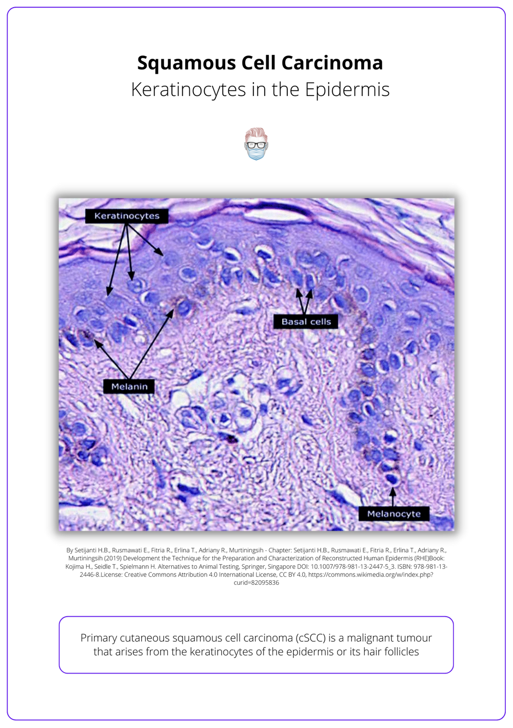 Squamous Cell Carcinoma (SCC): Guidelines, Diagnosis, & Treatment