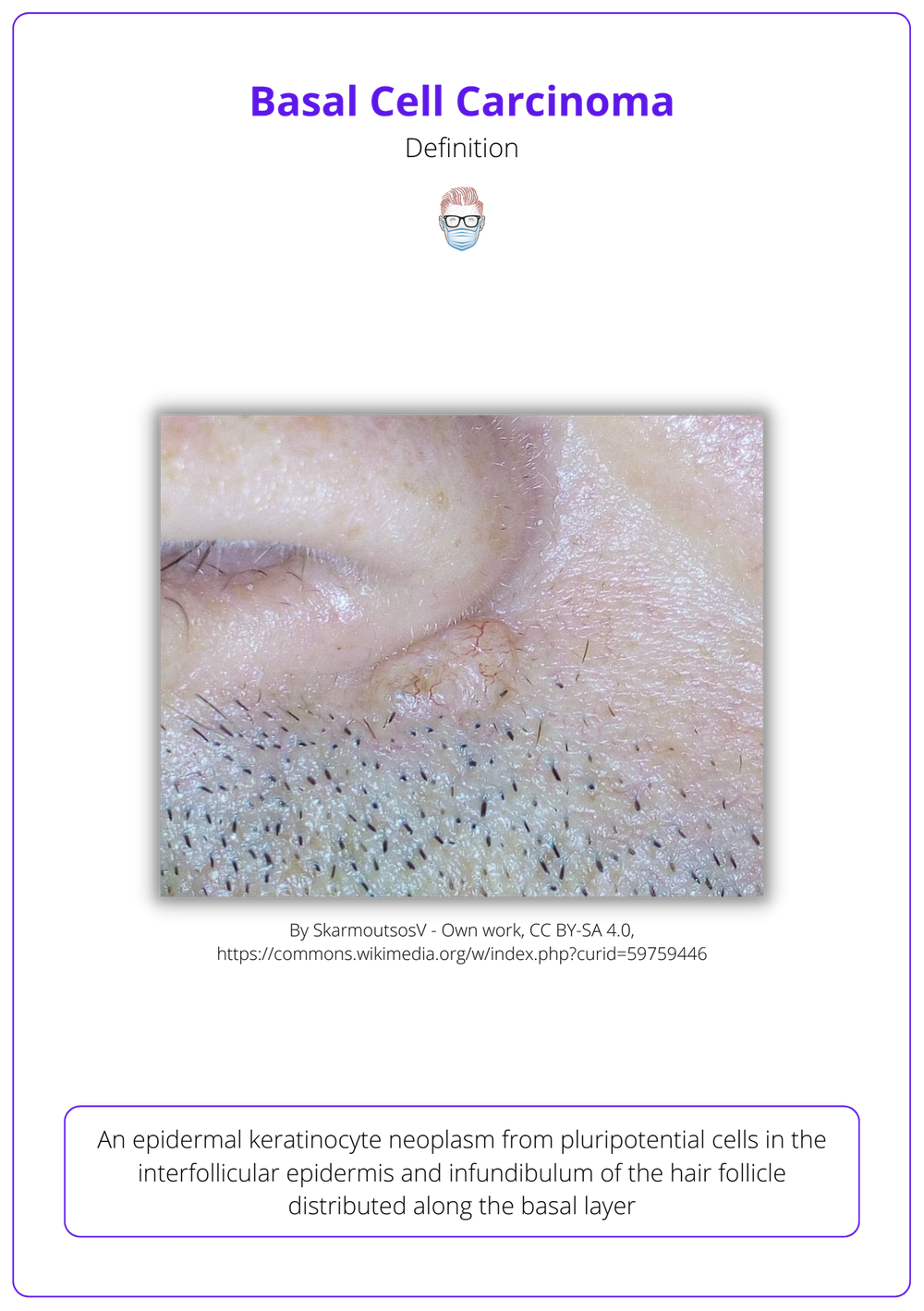 Basal Cell Carcinoma Bcc · Aetiology Diagnose Treat Follow Up 