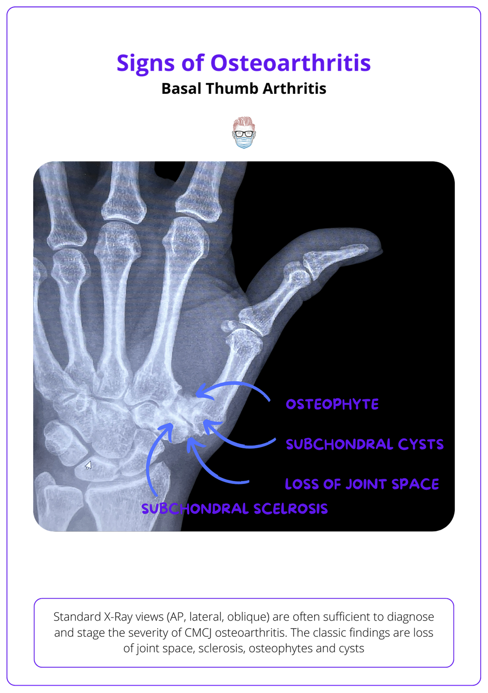 Basal Thumb Osteoarthritis Anatomy Pathophysiology Diagnosis Treatment