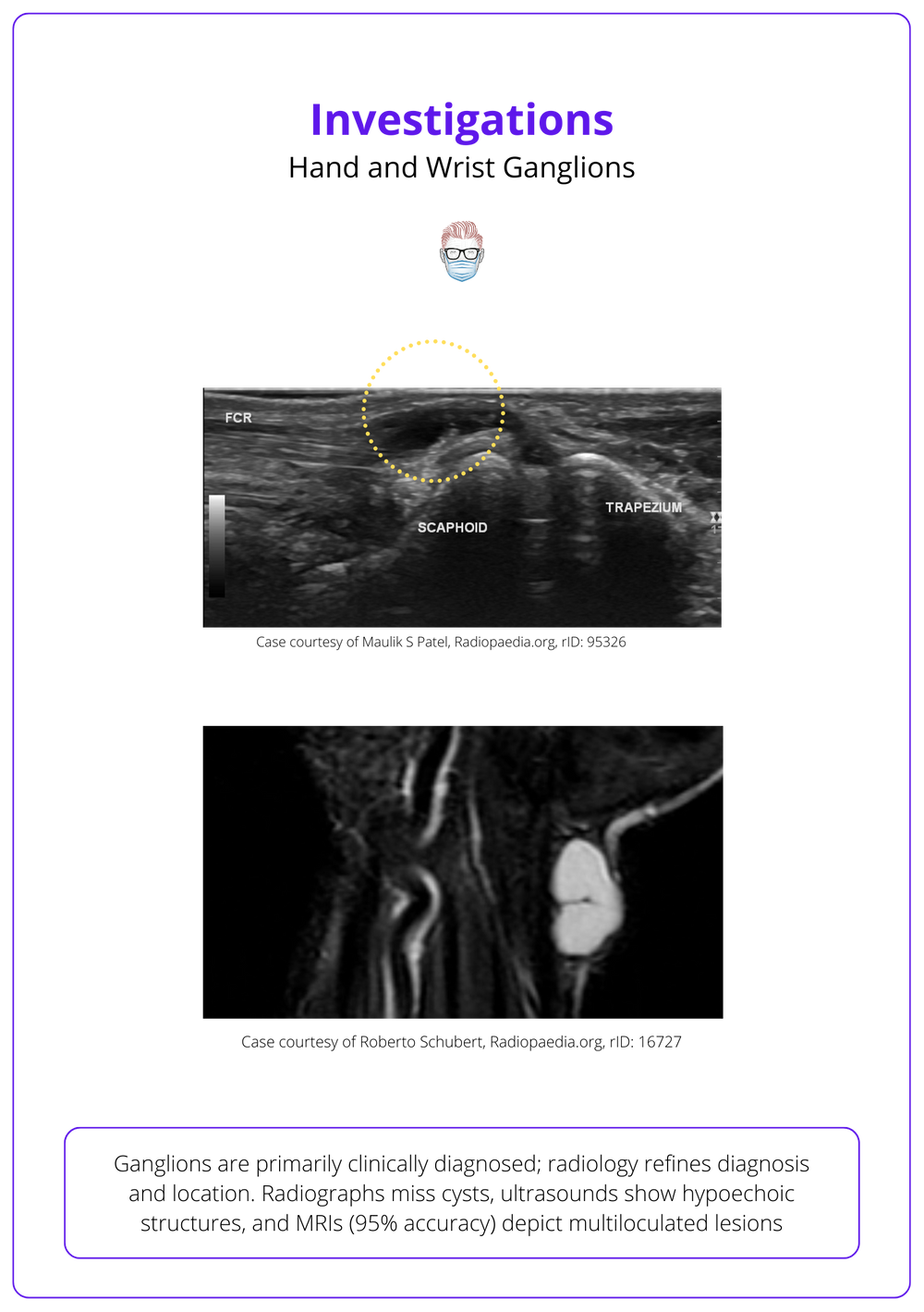 Ganglion Cysts of the Hand & Wrist Diagnosis and Treatment