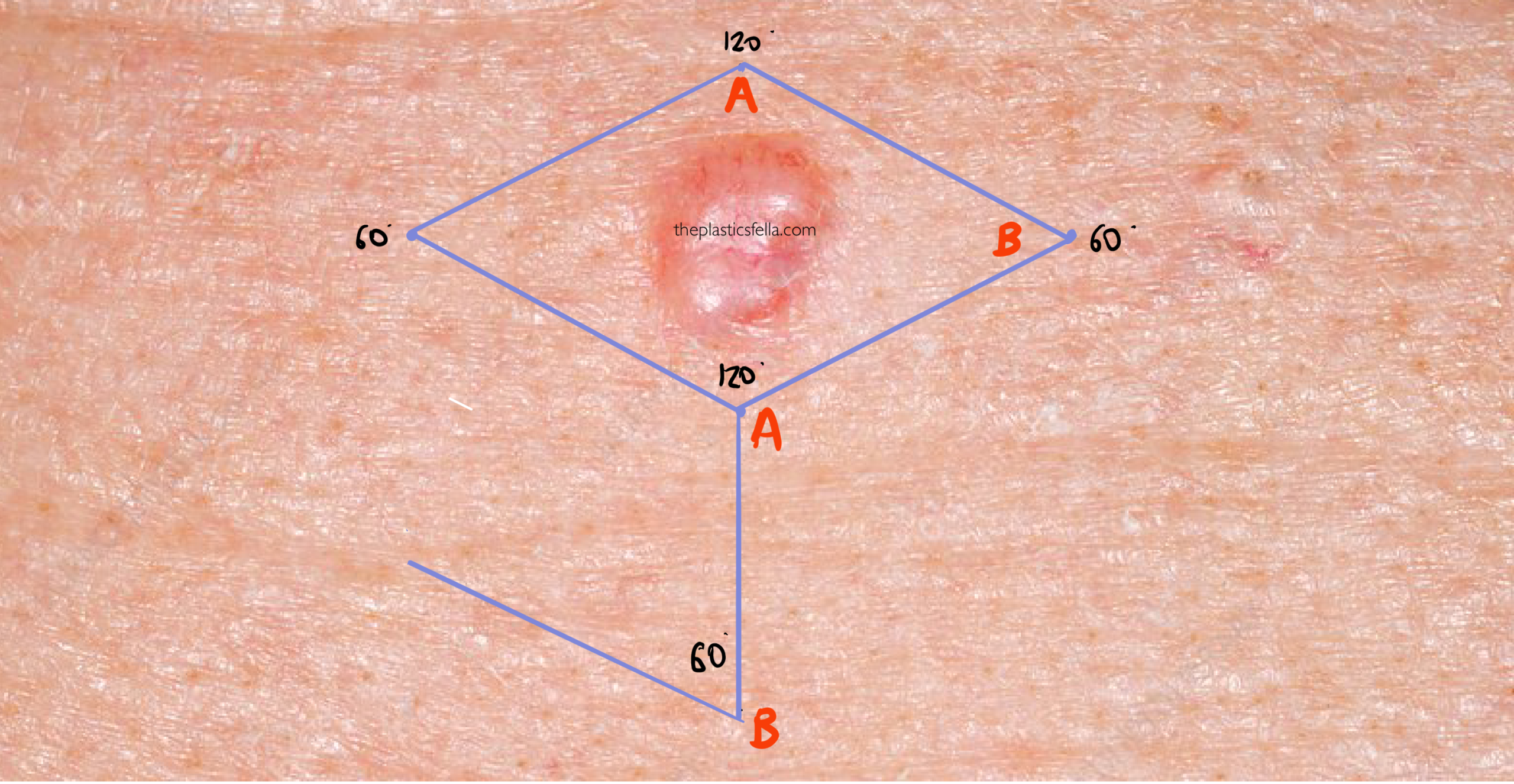 rhomboid-flap-indications-design-examples