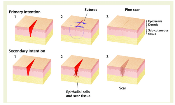 Techniques for Wound Closure