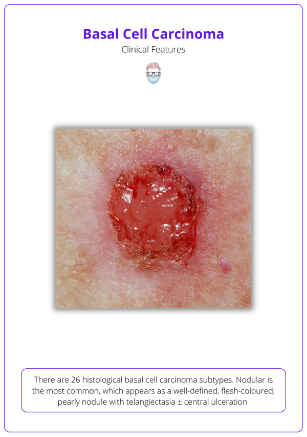 Basal Cell Carcinoma (BCC) · Aetiology, Diagnose, Treat, Followup