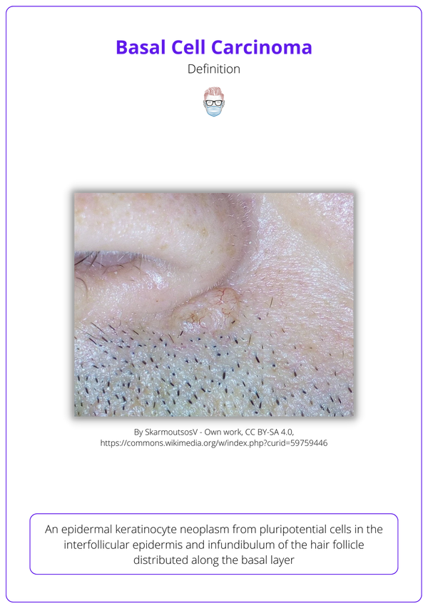 Basal Cell Carcinoma Bcc · Aetiology Diagnose Treat Follow Up 4589