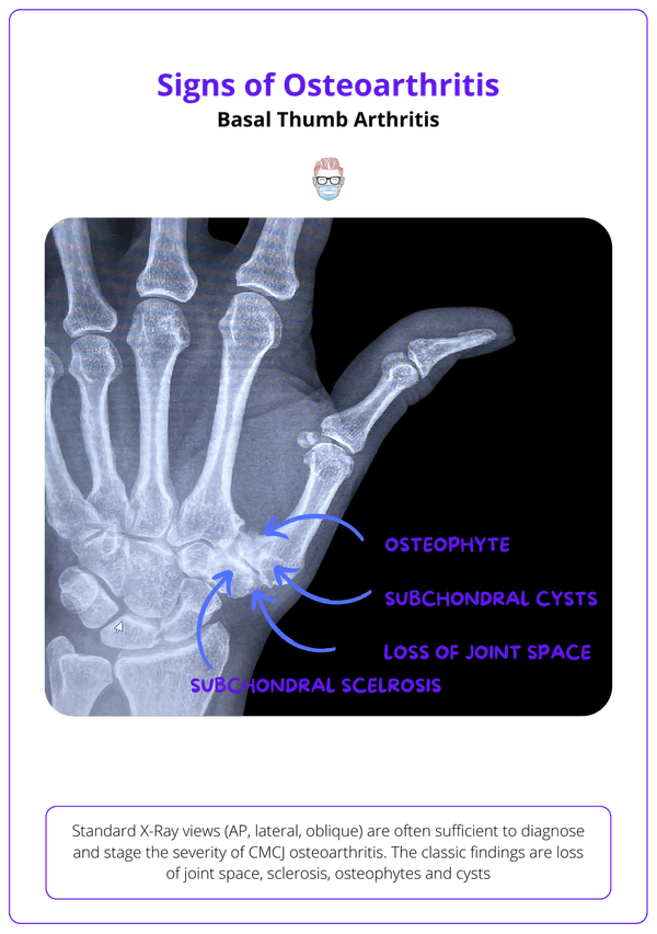 Basal Thumb Osteoarthritis: Anatomy, Pathophysiology, Diagnosis, Treatment