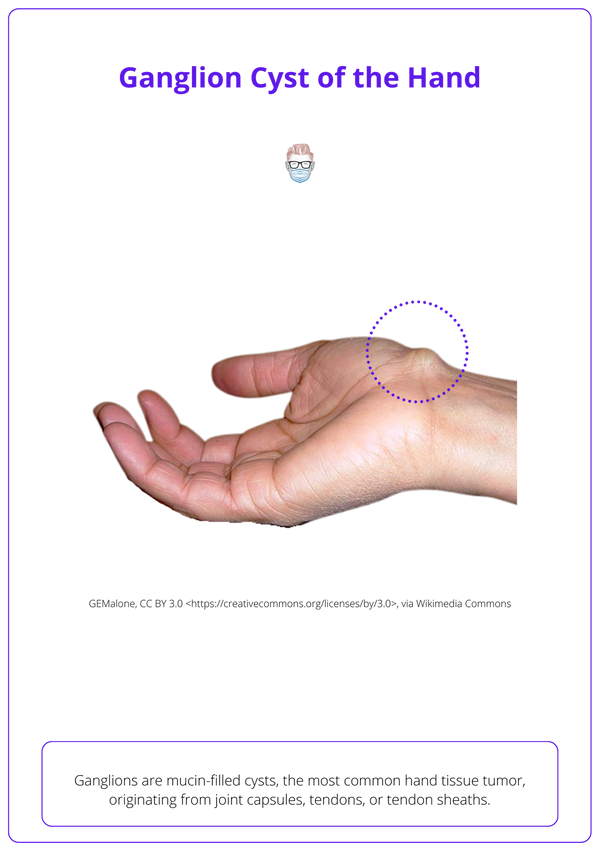 Ganglion Cysts Of The Hand And Wrist Diagnosis And Treatment