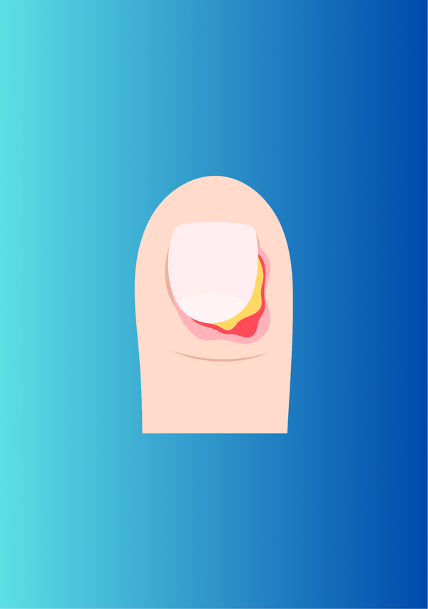 Seymour Fracture: Causes, Presentation, & Treatment